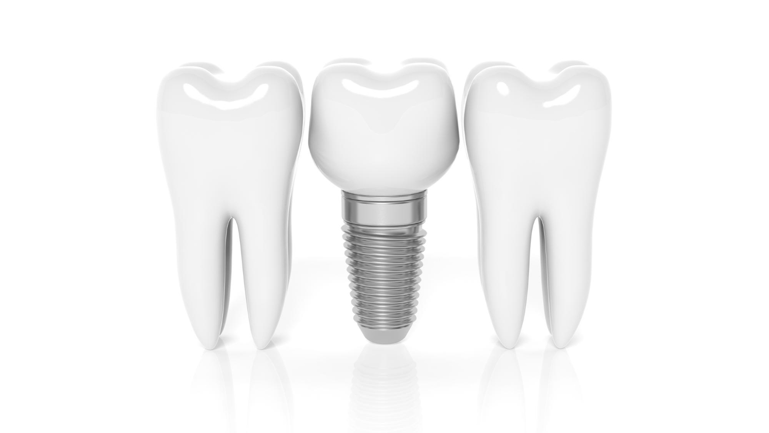 Cheap Dental Implants in Houston, TX