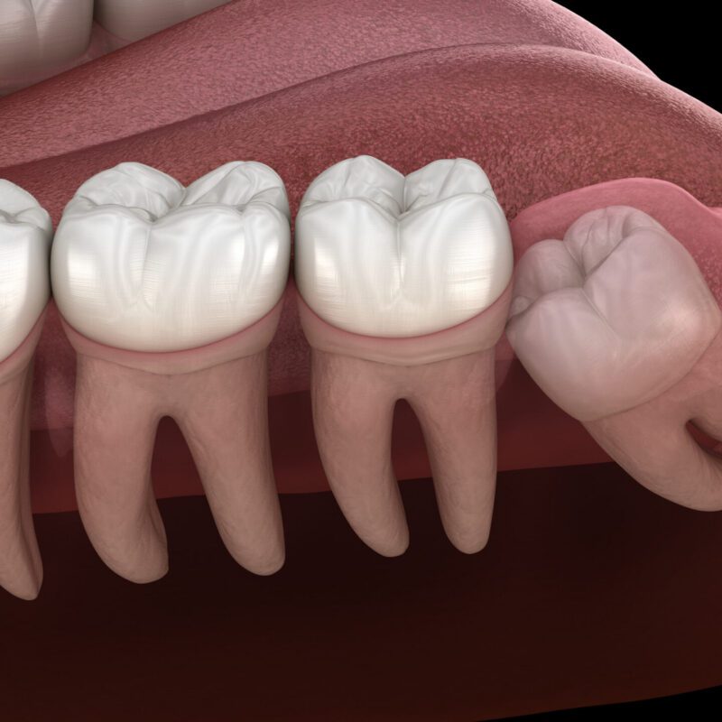 Wisdom Teeth Removal Cost Near Rosenberg, TX — Affordable Options | Best Dental