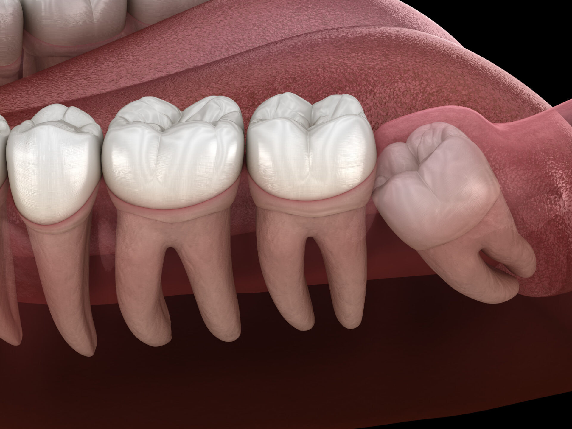 How Much Does Wisdom Teeth Removal Cost In Rosenberg, TX?