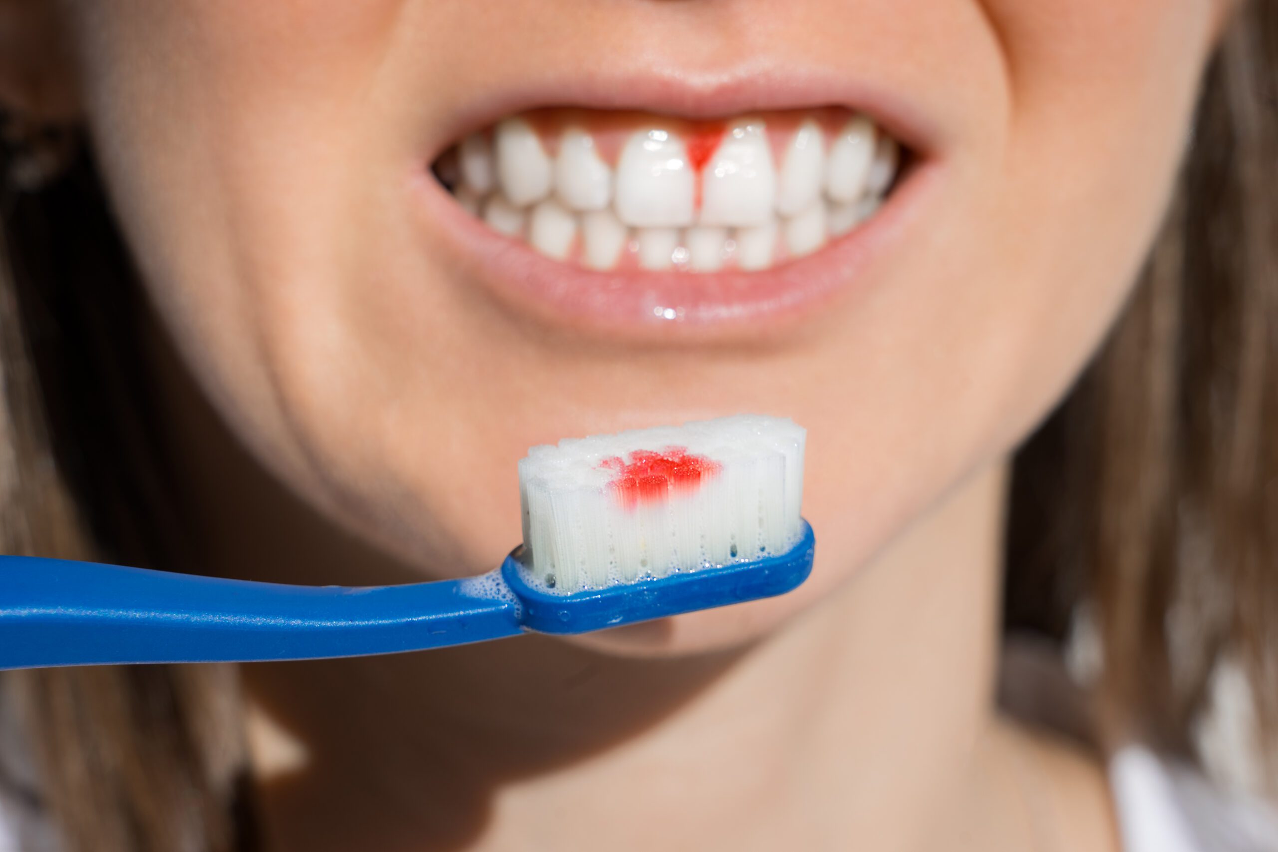 How Much Does A Deep Teeth Cleaning Cost In Houston, TX?