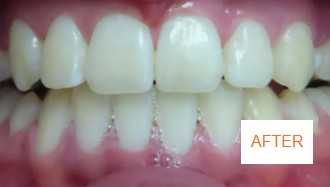 After braces case 1 at Best Dental near Katy, TX. Straightened front teeth result by Dr. Jasmine Naderi after complete braces treatment.