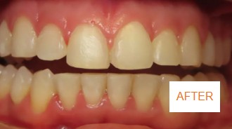 After braces case 2 at Best Dental near Katy, TX. Aligned smile result by Dr. Jasmine Naderi after braces treatment for Katy patient.