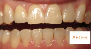 After braces case 3 at Best Dental near Katy, TX. Closed gaps and straight teeth result by Dr. Jasmine Naderi for Katy patient.