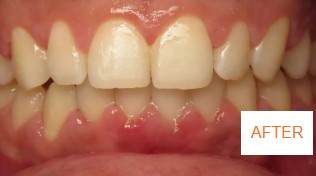 After braces case 4 at Best Dental near Katy, TX. Corrected bite and aligned smile result by Dr. Jasmine Naderi for Katy patient.