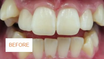 Before braces case 1 at Best Dental near Katy, TX. Adult patient with crowded front teeth before orthodontic treatment by Dr. Jasmine Naderi.