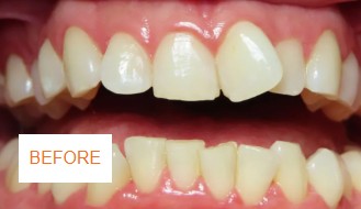 Before braces case 2 at Best Dental near Katy, TX. Adult patient with misaligned teeth before orthodontic treatment by Dr. Jasmine Naderi.