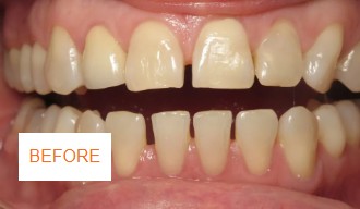 Before braces case 3 at Best Dental near Katy, TX. Adult patient with spacing and alignment issues before braces by Dr. Jasmine Naderi.