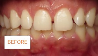 Before braces case 4 at Best Dental near Katy, TX. Adult patient with bite alignment issues before comprehensive braces by Dr. Jasmine Naderi.