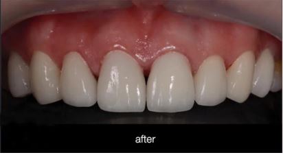 After same-day composite veneers at Best Dental in Richmond TX natural-looking smile