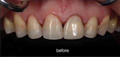 Before composite veneers at Best Dental in Richmond TX chipped, stained front teeth