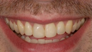 After same-day dental bonding at Best Dental in Richmond, TX. Natural-looking smile with chips repaired and gaps closed using color-matched composite resin sculpted chairside by Dr. Jasmine Naderi at $450 per tooth.