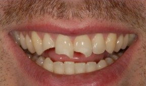 Before dental bonding at Best Dental in Richmond, TX. Chipped, gapped, and stained teeth before same-day cosmetic tooth bonding treatment.