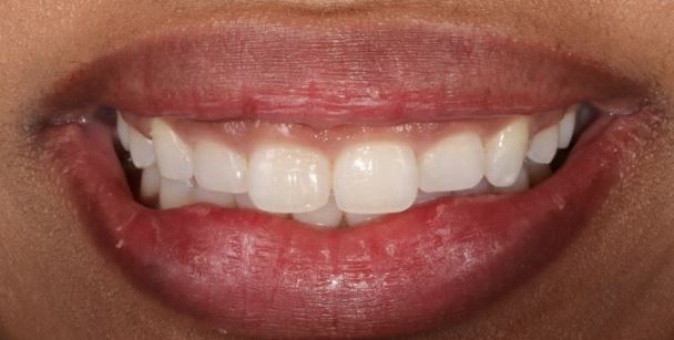Before gum contouring at Best Dental in Richmond TX — gummy smile with excess tissue