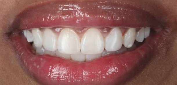 After laser gum contouring at Best Dental in Richmond TX — reshaped gum line