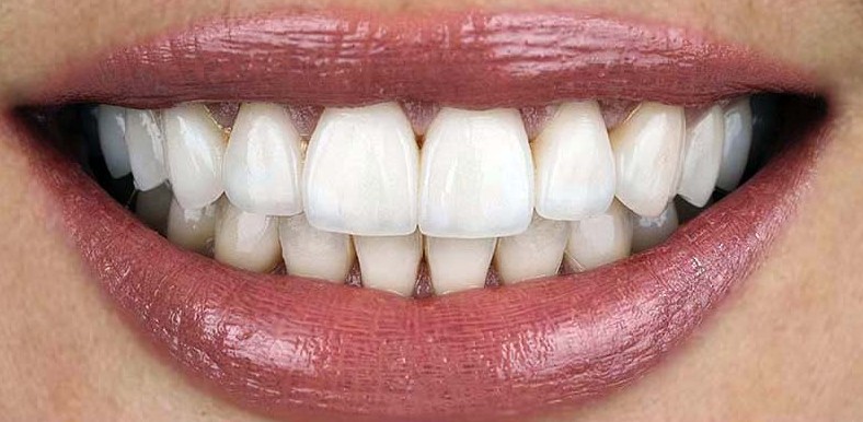 After ultra-thin Lumineers at Best Dental in Richmond, TX. Natural-looking bright smile with Cerinate porcelain veneers placed by certified Lumineers provider Dr. Jasmine Naderi.