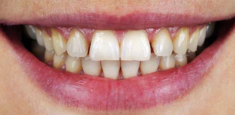 Before Lumineers at Best Dental in Richmond, TX. Stained and uneven teeth before no-prep Lumineers treatment.