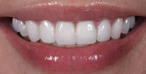 After custom porcelain veneers at Best Dental in Richmond, TX. Natural-looking smile with feldspathic or lithium disilicate (IPS e.max) veneers designed by Dr. Jasmine Naderi.