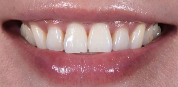 Before porcelain veneers at Best Dental in Richmond, TX. Stained, chipped, and uneven teeth before custom porcelain veneer treatment.