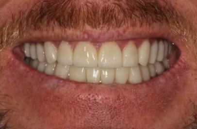 After complete smile makeover at Best Dental in Richmond TX