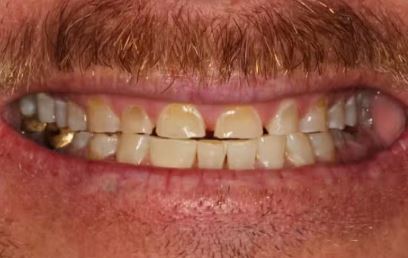 Before smile makeover at Best Dental in Richmond TX