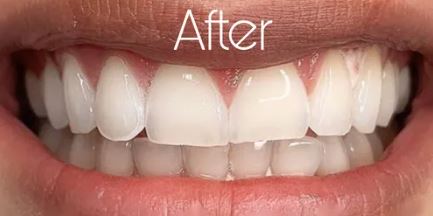 After professional teeth whitening at Best Dental in Richmond, TX. Bright white smile 6 to 10 shades whiter after in-office whitening treatment.