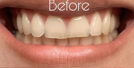 Before teeth whitening at Best Dental in Richmond, TX. Yellow and stained teeth before professional whitening treatment.
