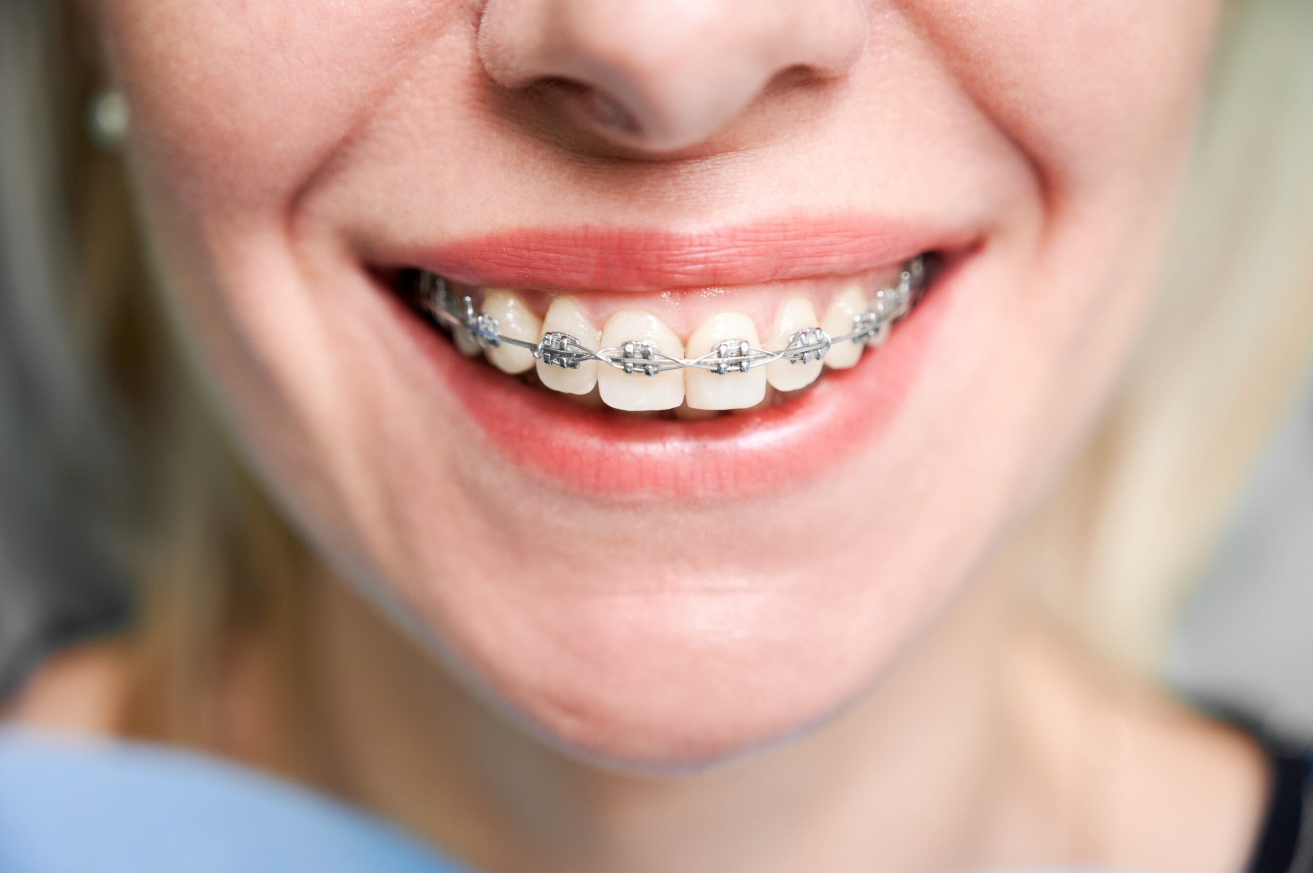 Adult braces patient near Houston TX at Best Dental