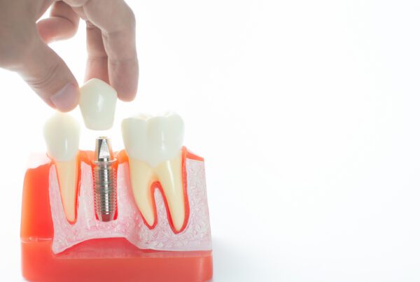 Does PPO Dental Insurance Cover Implants? | Delta, Cigna & More | Best Dental