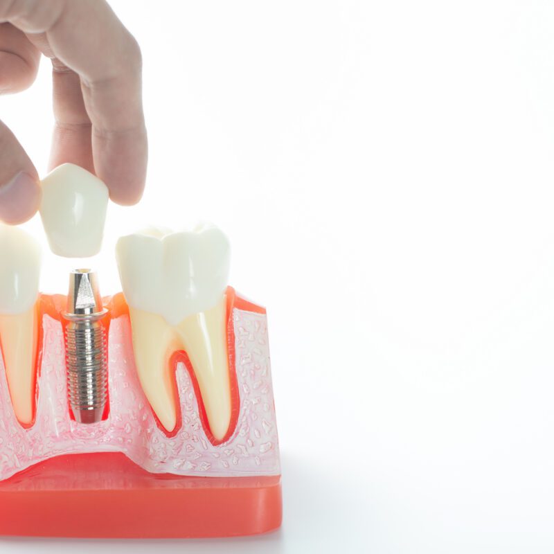 Does PPO Dental Insurance Cover Implants? | Delta, Cigna & More | Best Dental