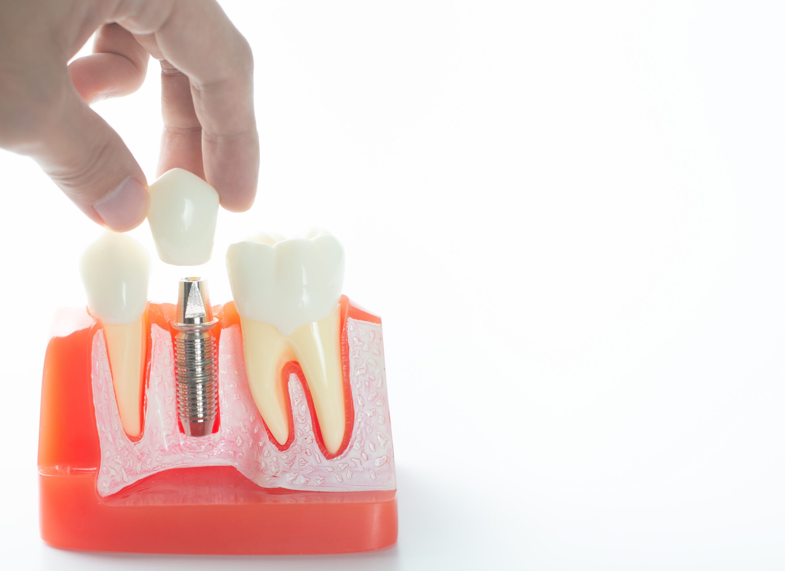 Does PPO Insurance Cover Dental Implants?