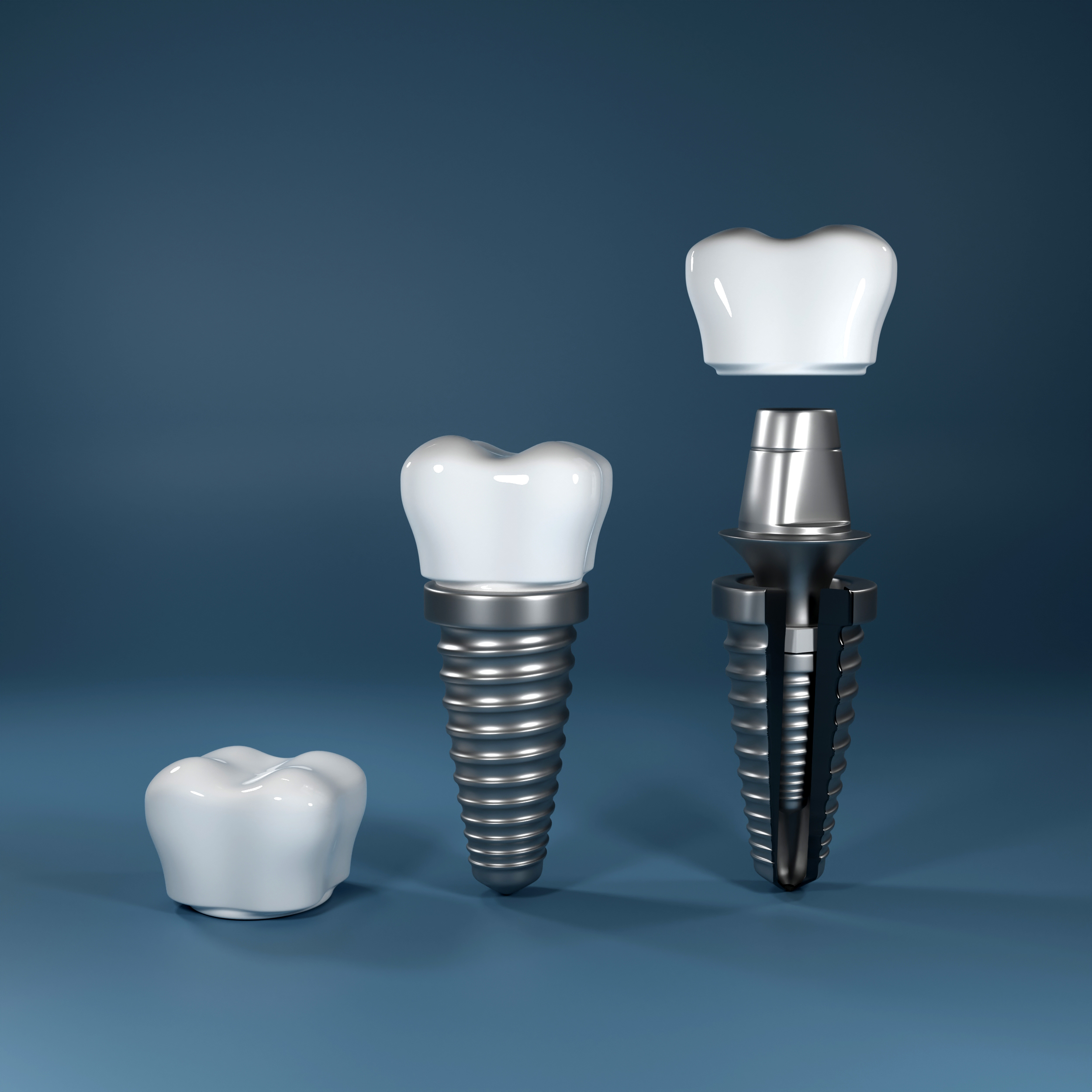 Dental implant procedure illustration at Best Dental Richmond TX 77407