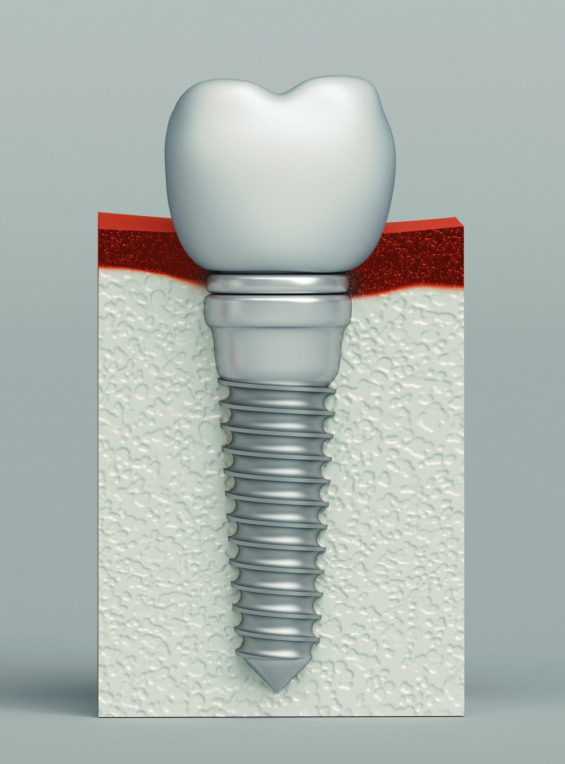 Dental implant procedure near Houston TX at Best Dental