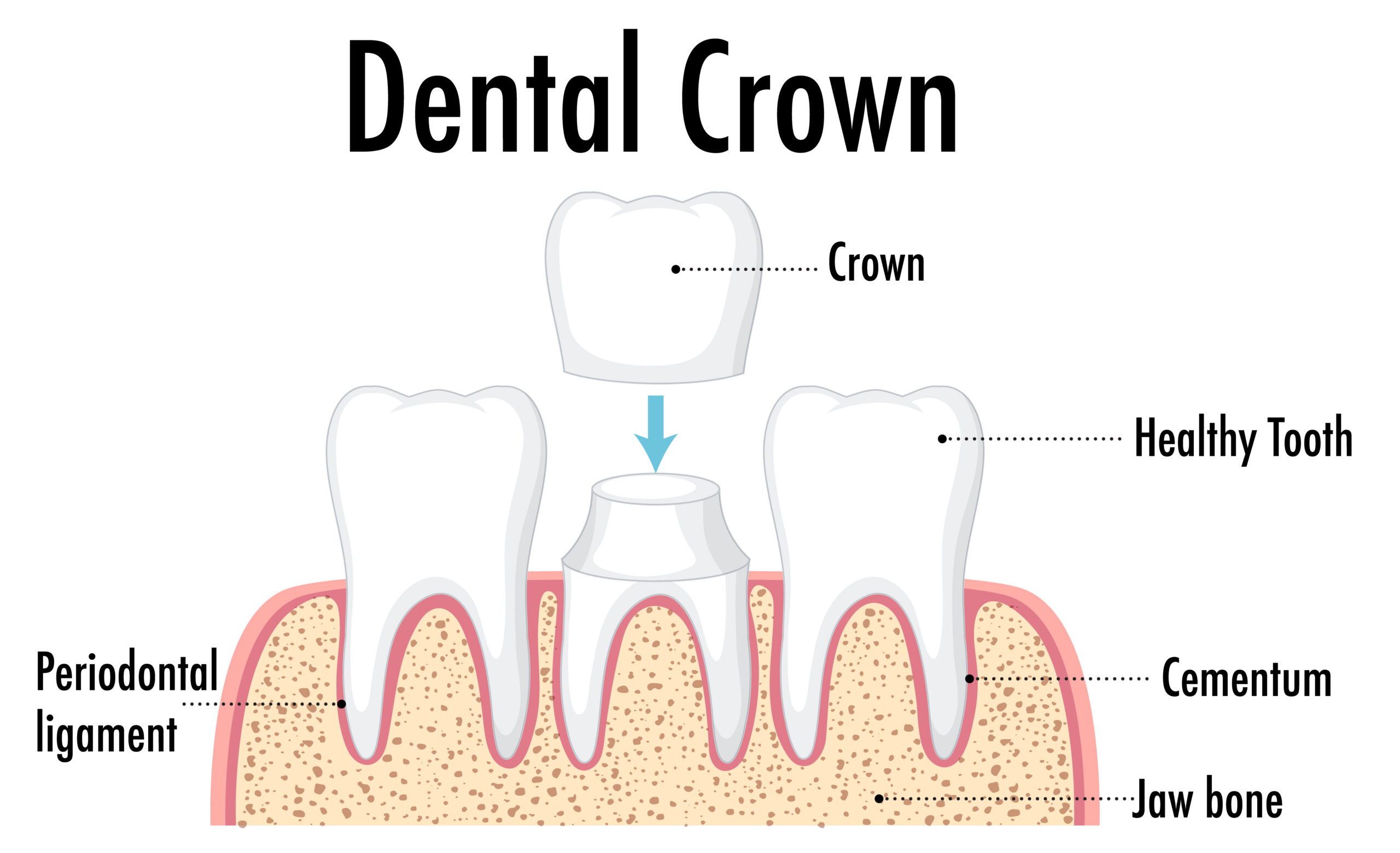 Affordable dental crown for Sugar Land patient at Best Dental — $950 flat for all materials