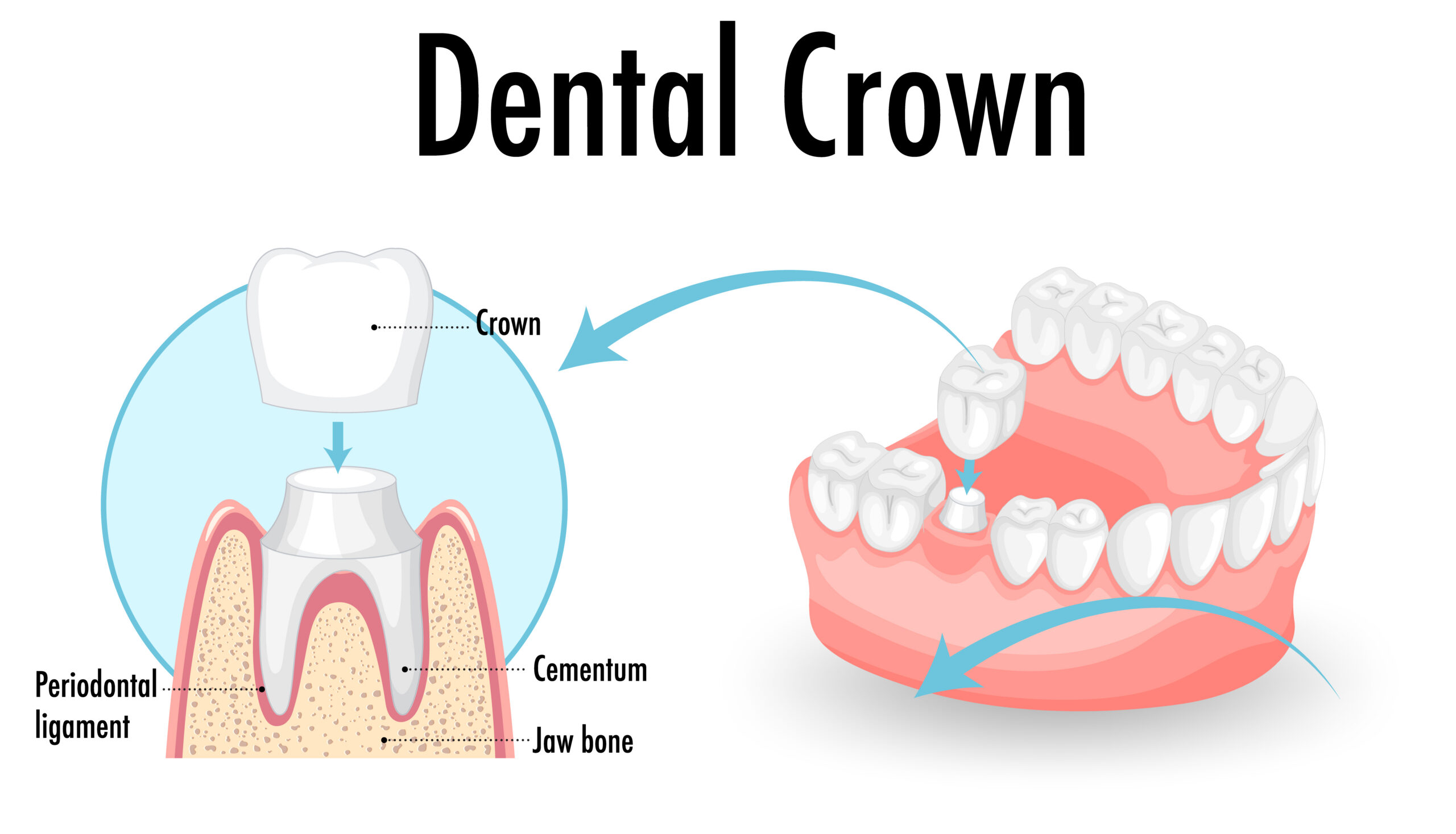 New dental crown placement for a Sugar Land patient at Best Dental in Richmond, TX