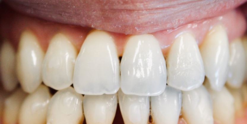 Invisalign after treatment results - Best Dental Richmond TX patient 1