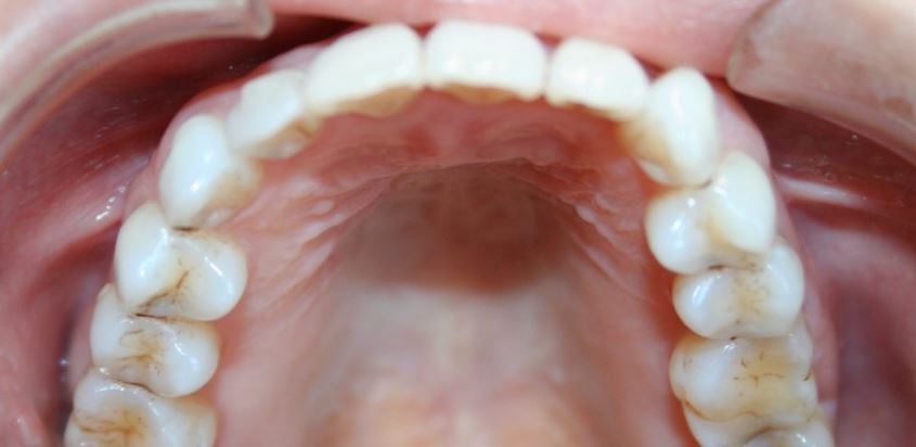 Invisalign after treatment results - Best Dental Richmond TX patient 2