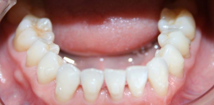 Invisalign after treatment results - Best Dental Richmond TX patient 3