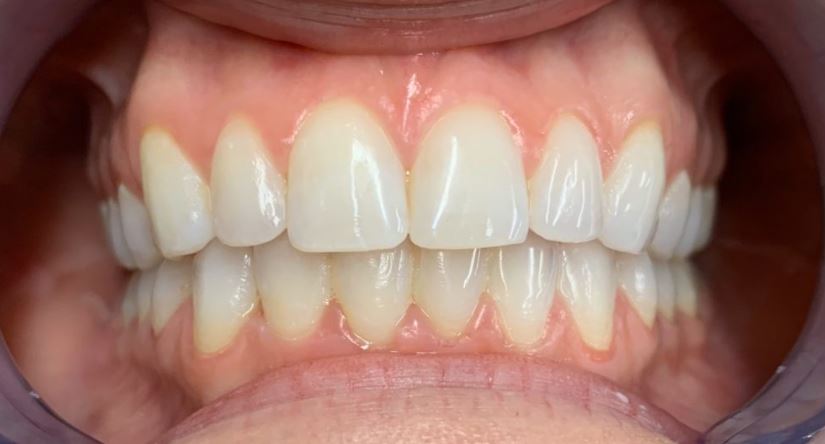 Invisalign after treatment results - Best Dental Richmond TX patient 4