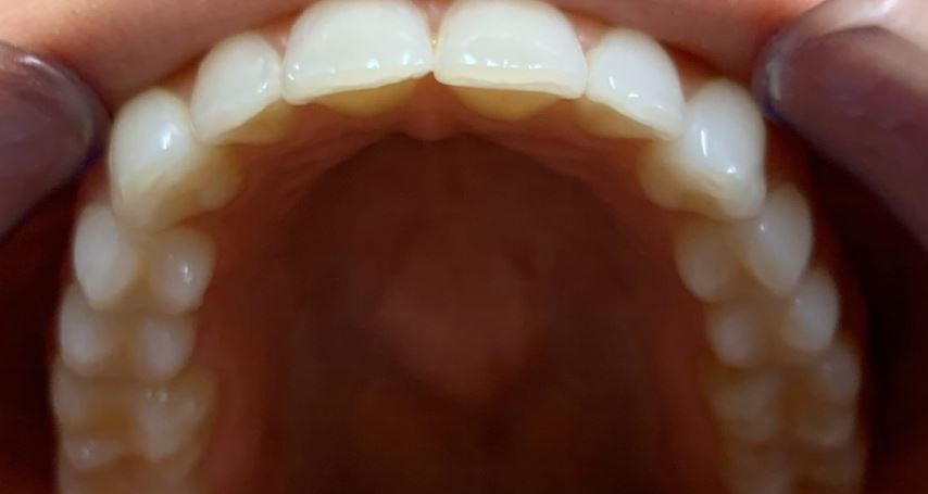 Invisalign after treatment results - Best Dental Richmond TX patient 5
