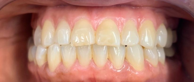 Invisalign after treatment results - Best Dental Richmond TX patient 6
