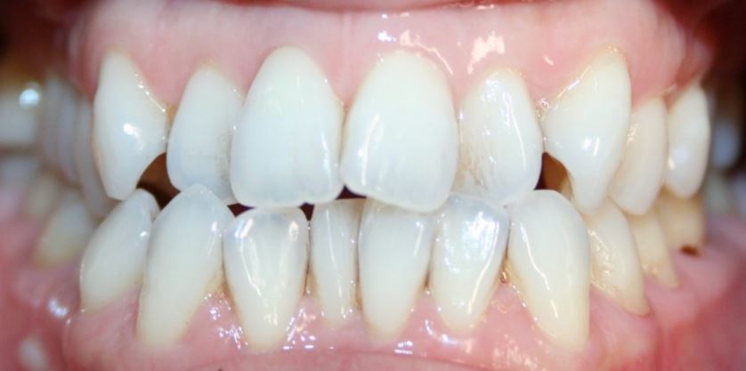 Invisalign before treatment - Best Dental Richmond TX patient 1