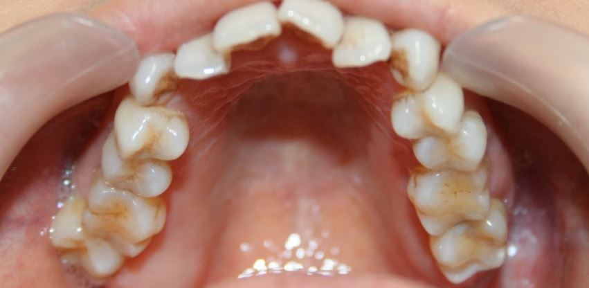 Invisalign before treatment - Best Dental Richmond TX patient 2