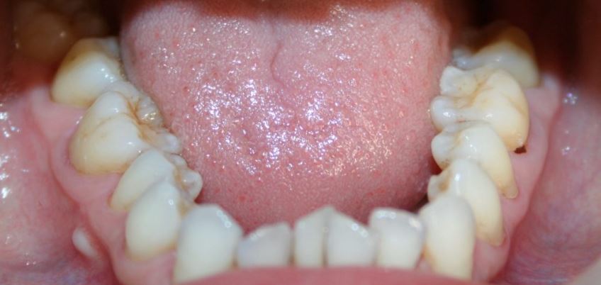 Invisalign before treatment - Best Dental Richmond TX patient 3