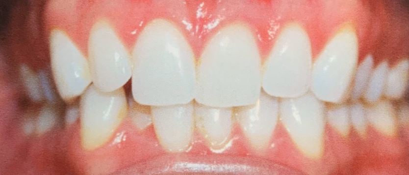 Invisalign before treatment - Best Dental Richmond TX patient 4
