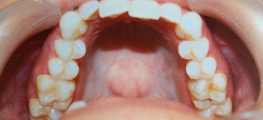 Invisalign before treatment - Best Dental Richmond TX patient 5