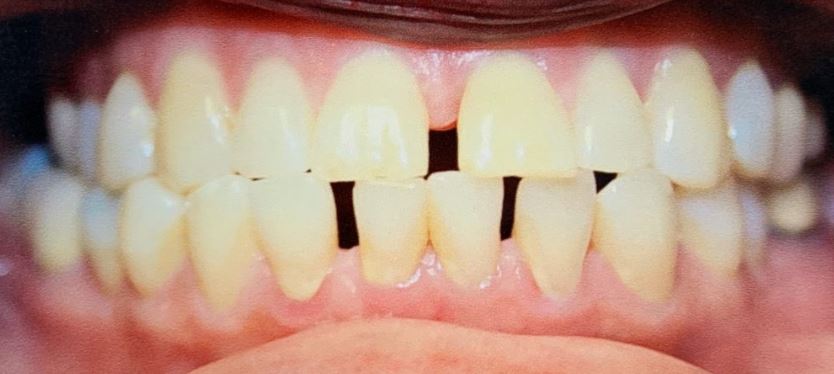 Invisalign before treatment - Best Dental Richmond TX patient 6