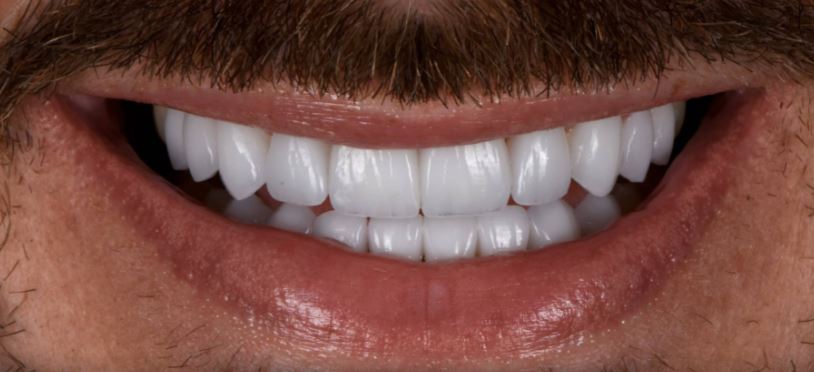 Porcelain veneers after treatment results - Best Dental Richmond TX patient 1