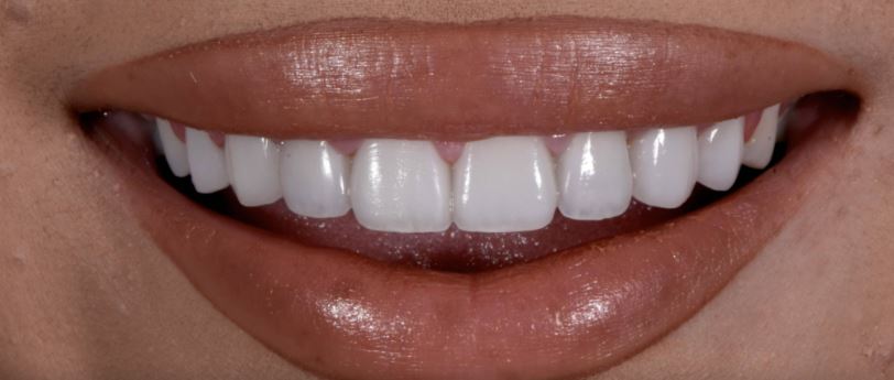Porcelain veneers after treatment results - Best Dental Richmond TX patient 2