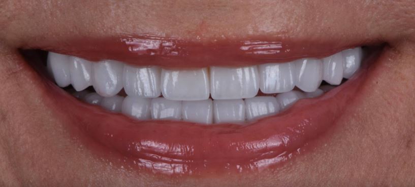 Porcelain veneers after treatment results - Best Dental Richmond TX patient 3