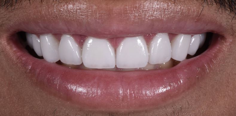 Porcelain veneers after treatment results - Best Dental Richmond TX patient 4